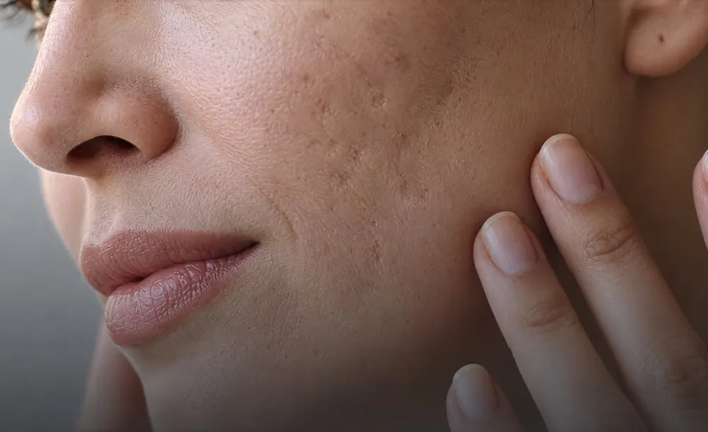Close-up of acne scarring on the cheek